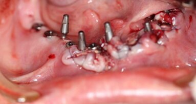 Implantacja z wykorzystaniem szablonu nawigacyjnego 3D – opis przypadku