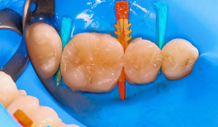 Fig. 2: Immediately after polymerisation, the composite is covered with an oxygen inhibition layer. 