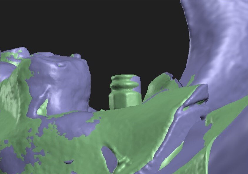 Fig. 6: Implant WG02l, buccal view. The figure shows two superimposed models. The green model is one with implants and the purple model one with inserts. The figure shows that the implant is displaced in relation to the insert, but their axes are approximately parallel to each other.
