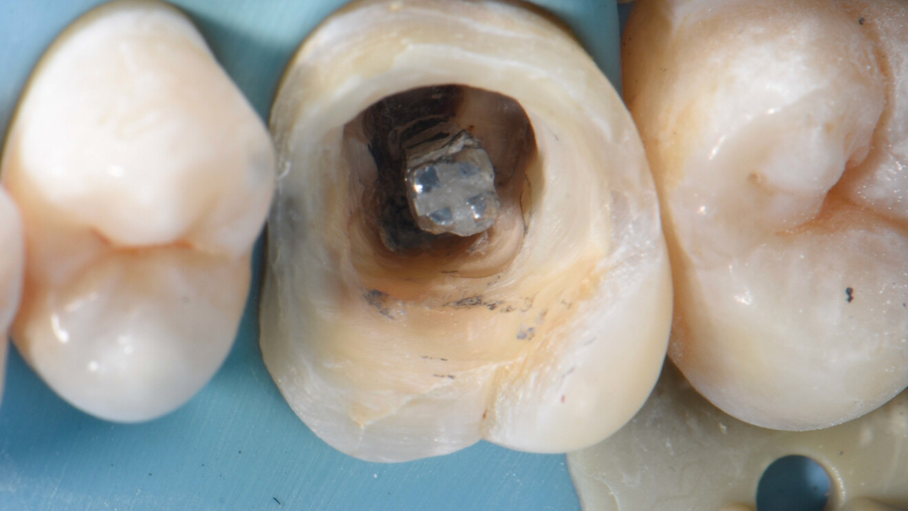 Fig. 6: Threaded metal post exposed using small burs, air abrasion and ultrasonic tips.