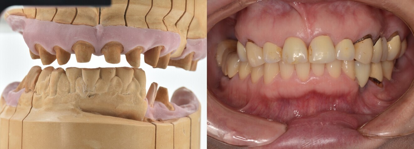 Figs. 2a & b: Initial situation with severe peri-implantitis.