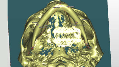 Asimmetria scheletrica: analisi 3D per diagnosi precise