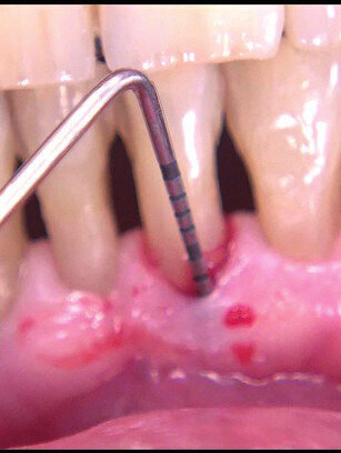 Figg. 6a, 6b - Sondaggio dopo terapia causale.