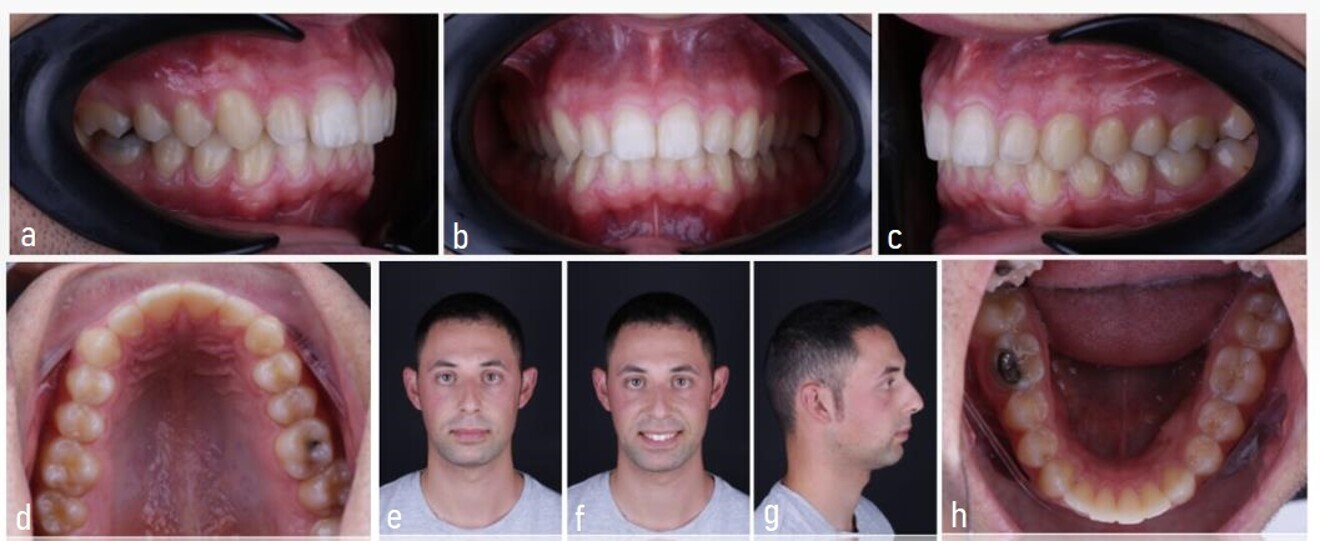 Figs. 30a–h: (a–e) Intra-oral and (f–h) extra-oral photographs taken on 23 June 2021. 