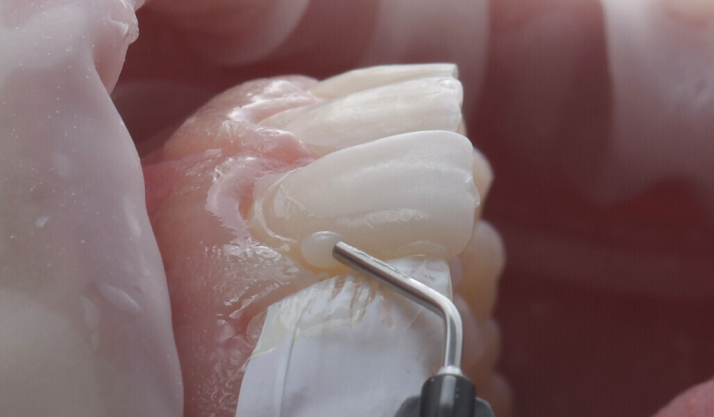 Fig. 12: Application of composite material to restore the defect.