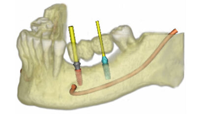 SimPlant® 2011 – Pianificazione semplice e veloce del trattamento implantologico 3D