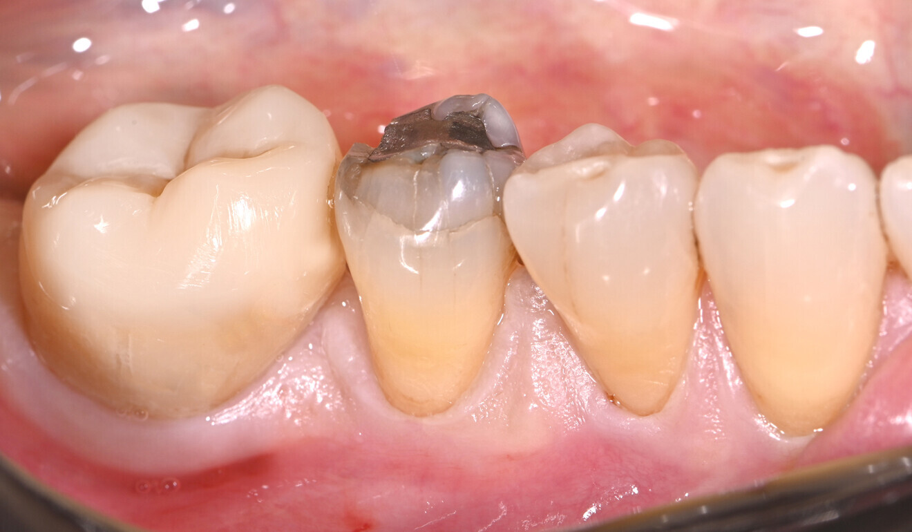 Fig. 2: Initial situation, buccal view. 