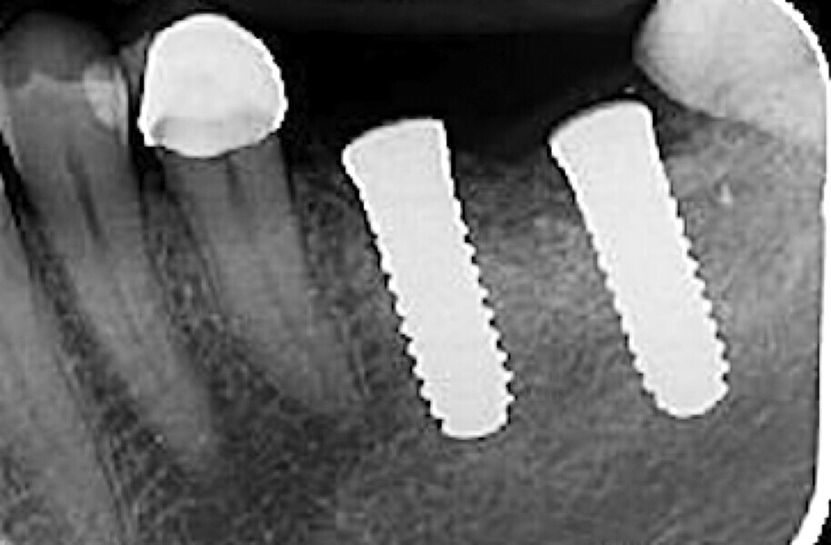 Fig. 34 : Radiographie de contrôle à deux mois.