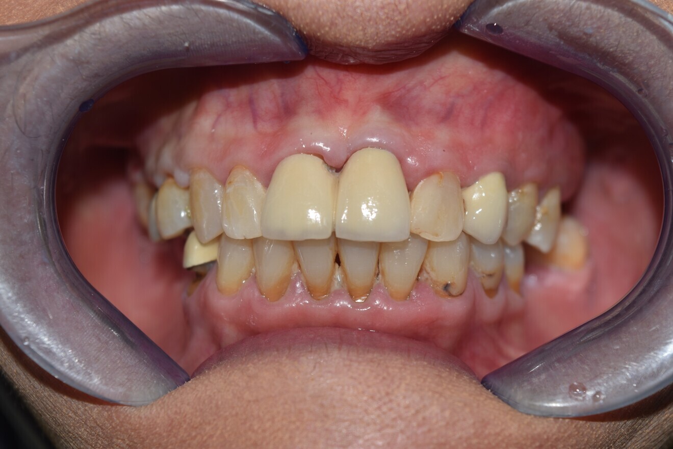 Fig. 5d: 2-unit metal fused porcelain bridge incorporated.