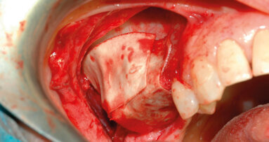 Criteri di prevedibilità nell’aumento dei volumi ossei: biomateriali o sostituti ossei?
