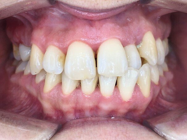 Photo de face début de traitement (Copyright : Dr Edouard Negre)