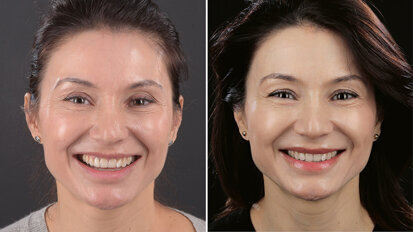 Preoperative digital planning