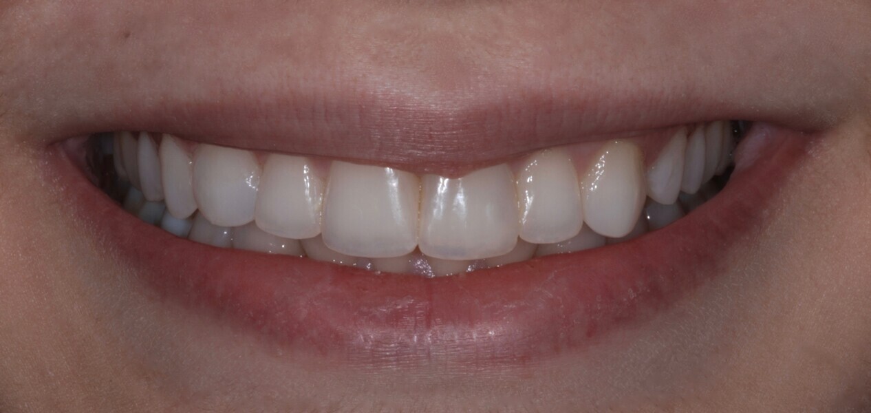 Fig. 16: Smile frontal view after treatment.