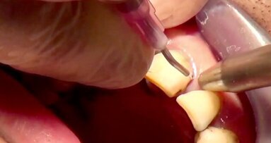 Experte erklärt photodynamische Therapiemethode