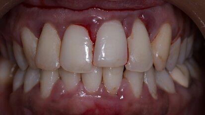 Recent study in Japan finds a possible link between bruxism and periodontal disease