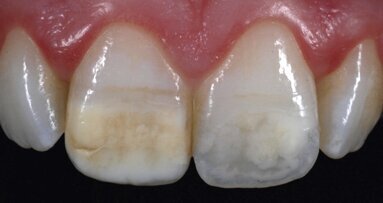 Estética y blanqueamiento dental en la era digital (Capítulo 6)