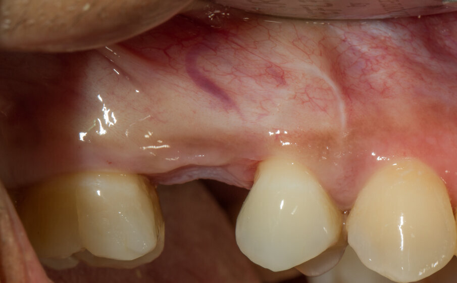 Fig. 17 - Vista vestibolare.