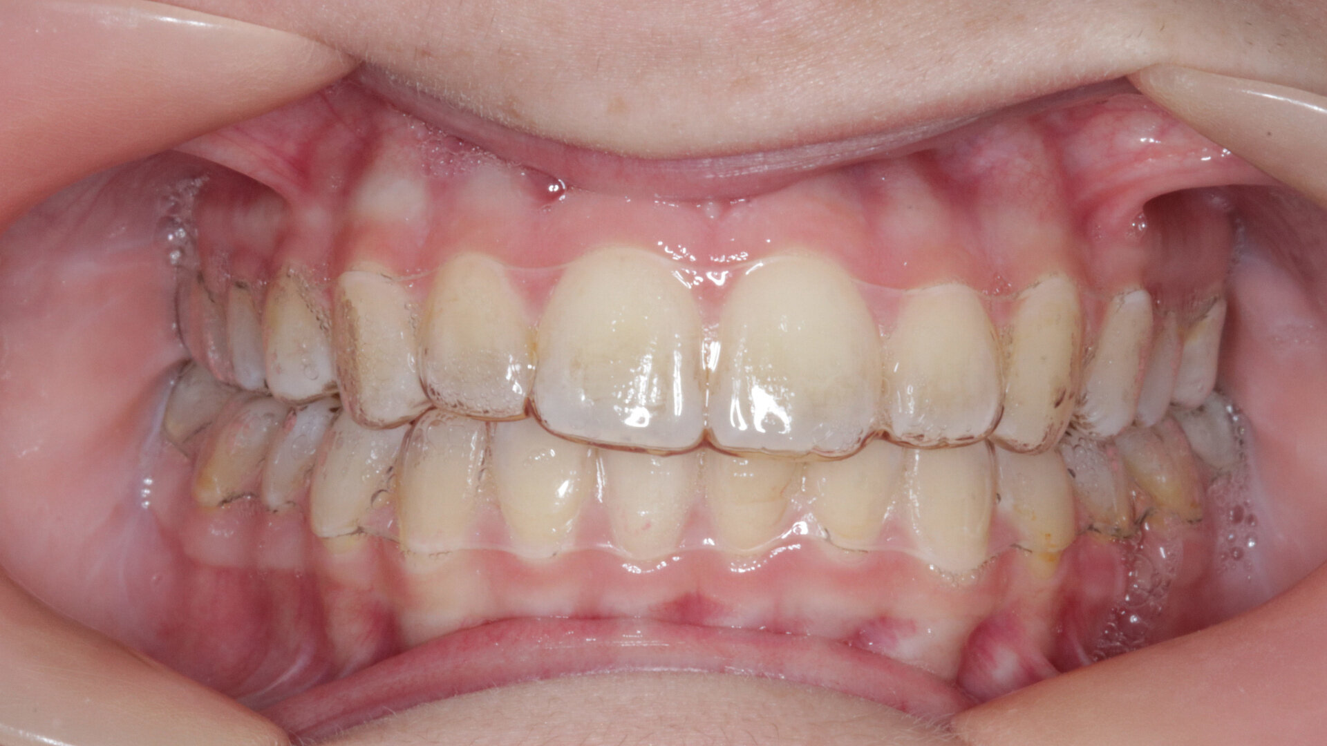 Boosting facial aesthetics through a hybrid approach of the Carriere Motion appliance and Reveal clear aligners