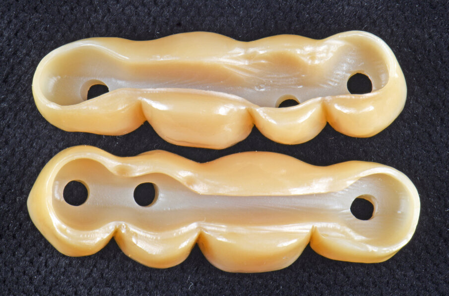 Obr. 13–18: Konstrukce Atlantis BridgeBase, zirkonové můstky a finální náhrady.