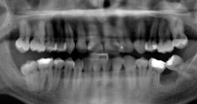 L’utilizzo  della corticotomia e delle miniscrew nel trattamento del paziente adulto. Case report