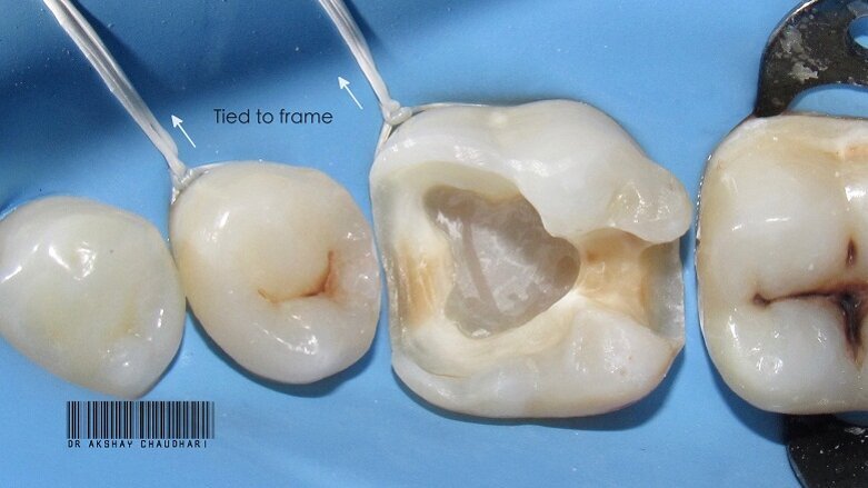 Rubber dam- Ace the basics
