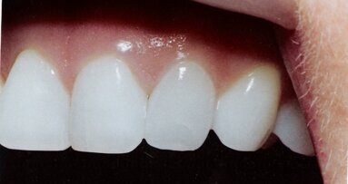 Μη επεμβατική αισθητική θεραπεία στο ετήσιο Βρετανικό Οδοντιατρικό Συνέδριο