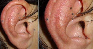 Auricoloterapia ed odontoiatria: nuove sinergie per l’odontoiatria olistica