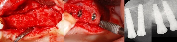 Fig. 6 - Fase di inserimento implantare. Al sollevamento del lembo si osserva la rigenerazione avvenuta in posizione 2.4 e 2.5 e si procede all’inserimento di quattro impianti osteoingrati; il prelievo del campione bioptico avviene in corrispondenza all’elemento 2.7. A destra, radiografia endorale degli impianti appena inseriti.
