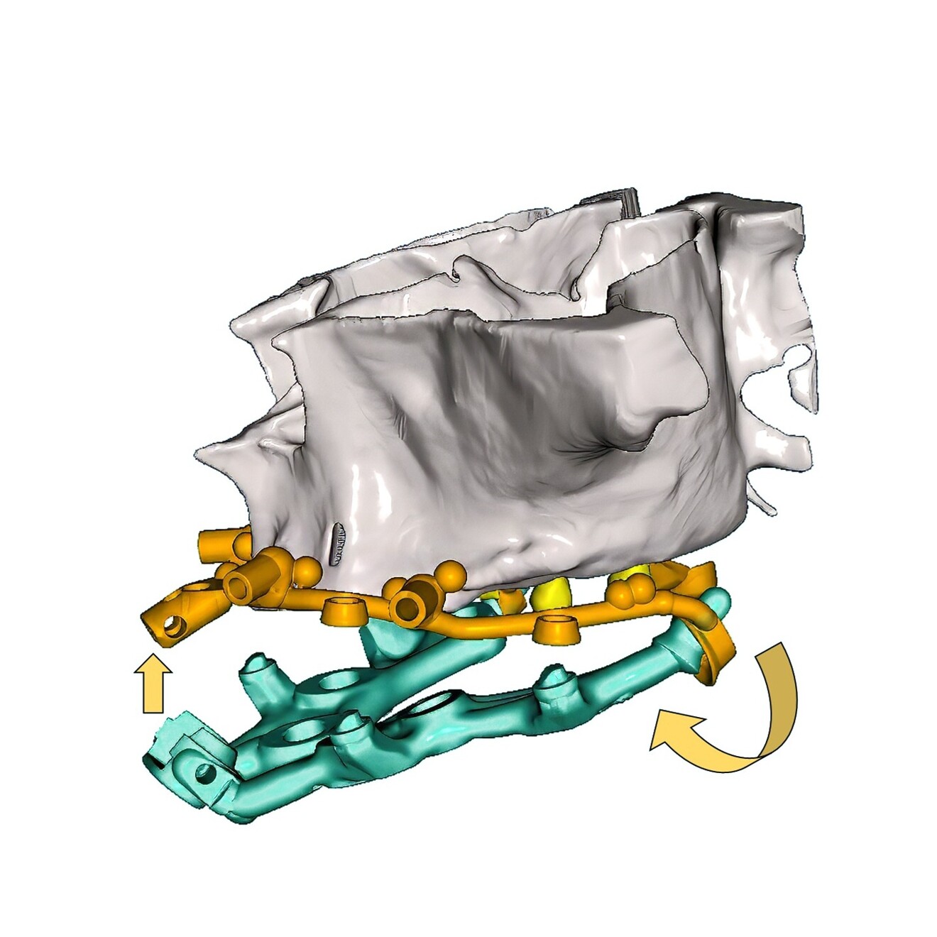 Fig. 13: Engagement of the osteotomy drill guide with the base frame using the slide-and-tilt mechanism (orange arrows).