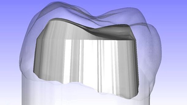 Les chercheurs développent des logiciels pour améliorer la rétention des couronnes dentaires