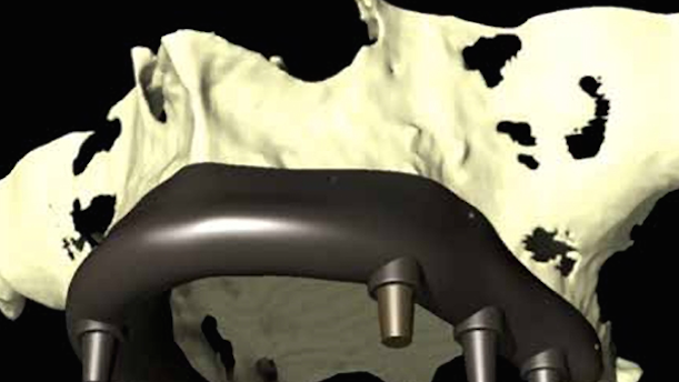 La revolucion de las barreras oclusivas