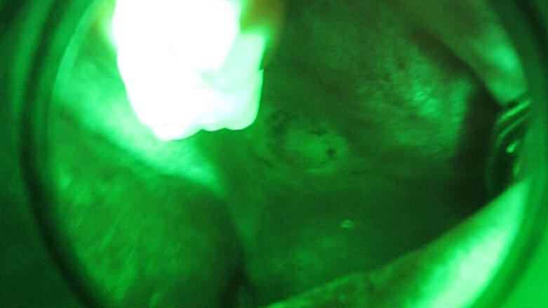 Lesione traumatica delle mucose orali in paziente con deficit mentali