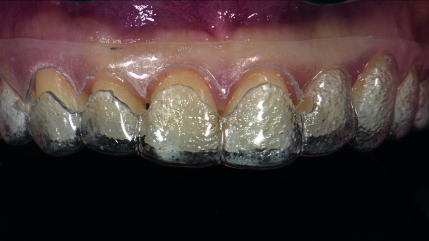 Figs. 6a : Adaptation intraorale du guide chirurgical utilisé pour l‘élongation coronaire.