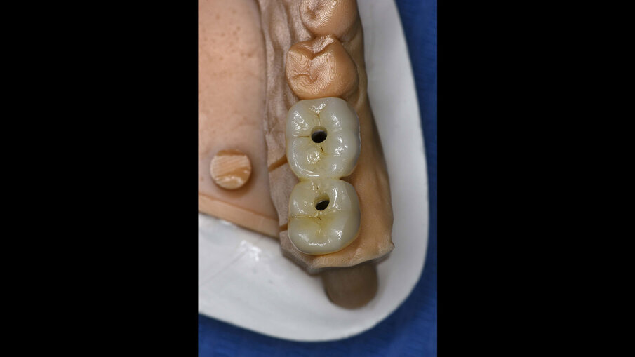 Figg. 18a, 18b_Elementi definitivi in zirconio avvitati.