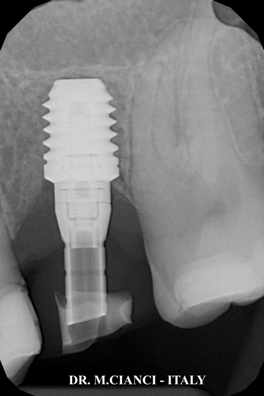 Fig. 13 - Follow up radiografico a 5 mesi.