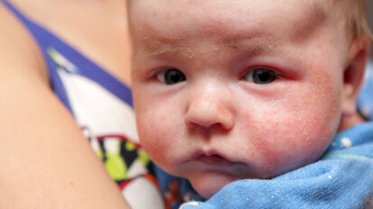 Researchers study link between dental agenesis and atopic dermatitis