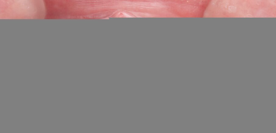 Fig. 20: Vertical sectioning of the root and atraumatic extraction of the palatal half in the socket shield technique and placement of the implant into site #21.