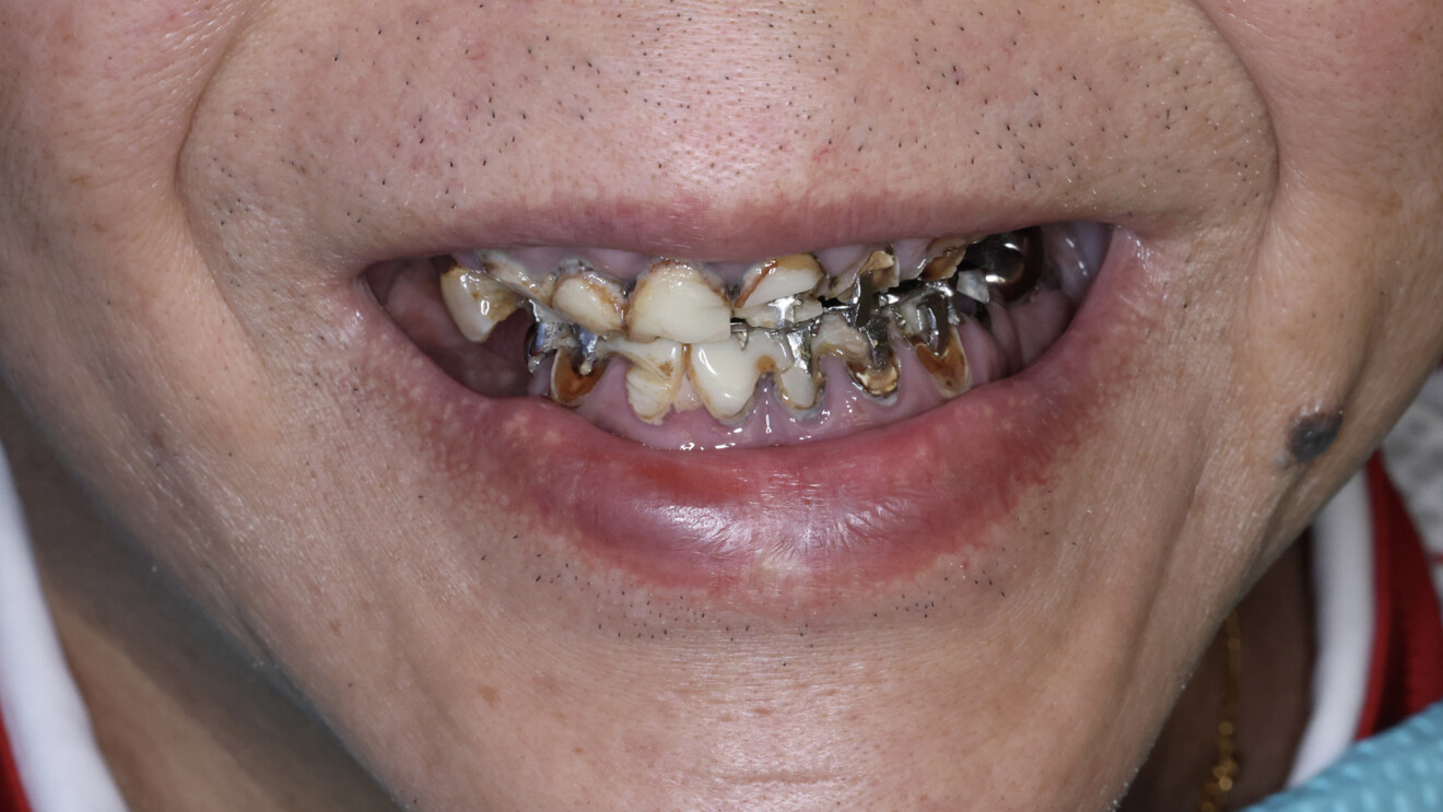 Fig. 1a: Preoperative situation. Extra-oral frontal smile view showing the heavily restored and severely compromised dentition, including recurrent caries and defective restoration margins.