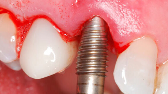 Άμεση τοποθέτηση εμφυτεύματος με οστεοτόμους Paltop για οστική διεύρυνση