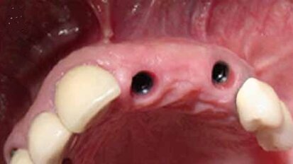 Šrafovima retinirana, implantatima nošena fiksna parcijalna proteza (FPP)