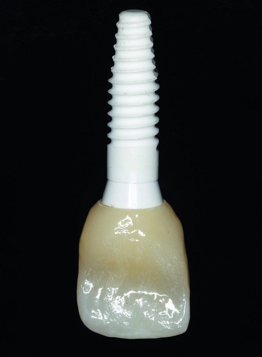 Fig. 10b: The definitive zirconia crown was fixed to the customised abutment made of alumina-toughened zirconia.
