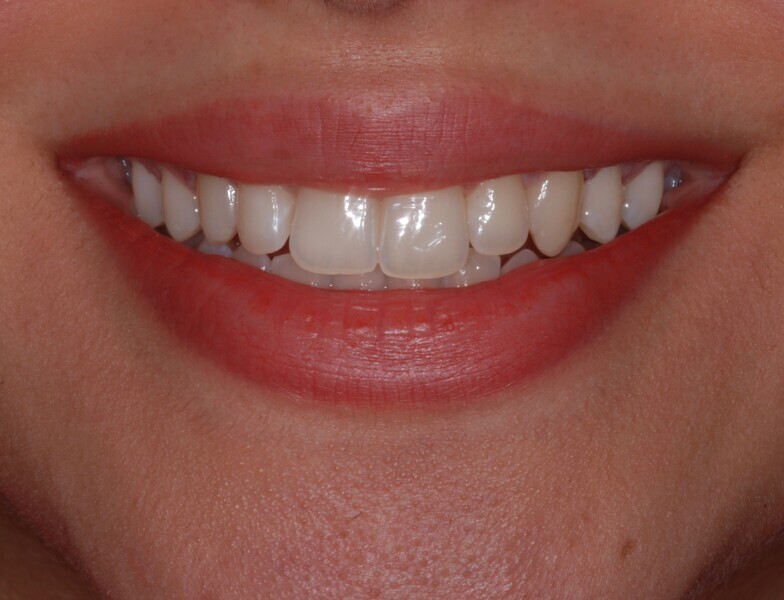 Fig. 6: Smile frontal view after treatment.