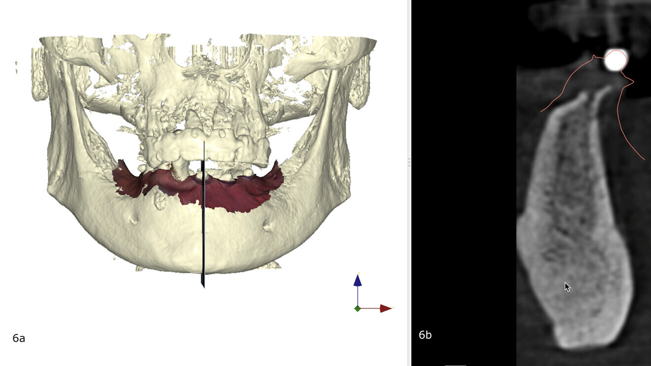 Figs. 6a et b : Planning implantaire (logiciel DTX Studio Implant) : quatre implants ont été planifiés. (a) La vue vestibulo- linguale met en évidence l’intérêt des billes radio-opaques sur les autocollants pour la bonne combinaison des (b) données DICOM et STL.