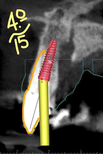 Fig. 7c: mplant in position #11.