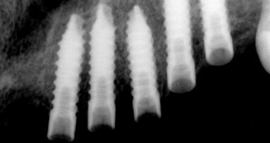 UIS Impladenta – Užití ve všech případech!