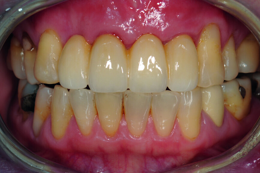 Fig. 47: Protrusion just after delivery.