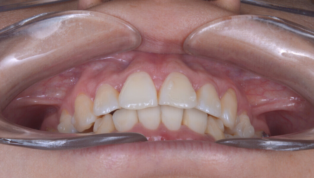 Fig. 6b: Intra-oral and occlusal photographs during treatment (after the 32nd aligner pair).
