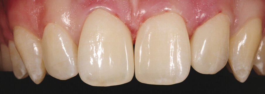 8. Gingiva je još uvijek iziritirana.