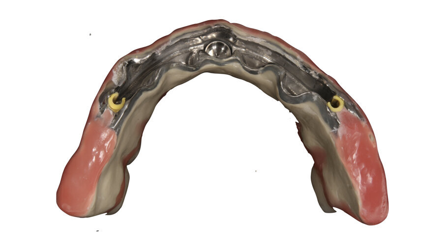 Figs. 16: Telescopic prosthesis with  BRILLIANT Crios restorations. Bottom view.