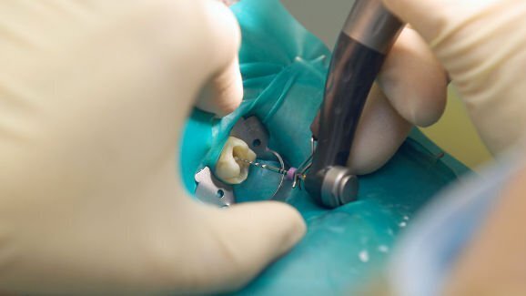 Publication d'un nouveau guide clinique en endodontie